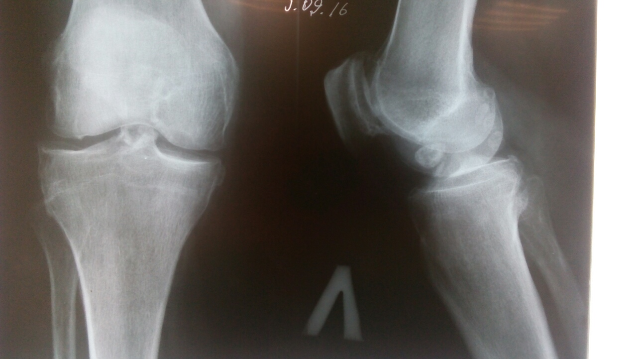  Свободные хондромные тела коленного сустава на рентгене