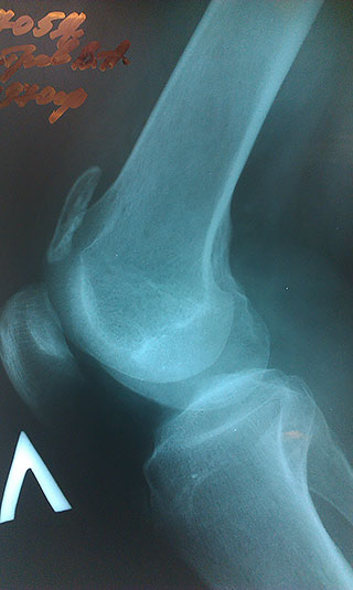 Рентгеновский снимок колена с отломком кости